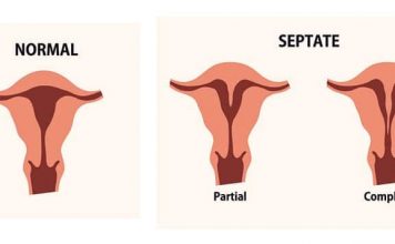 Septate Uterus