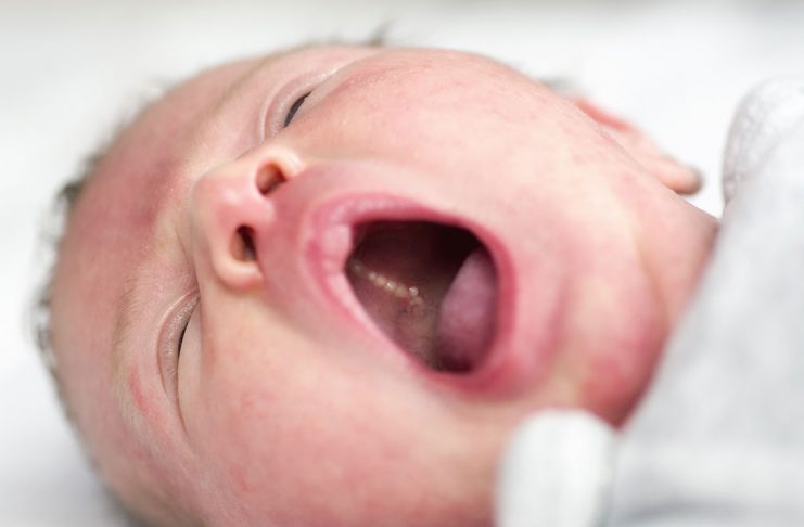 Epstein Pearls In Babies