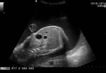 duodenal atresia