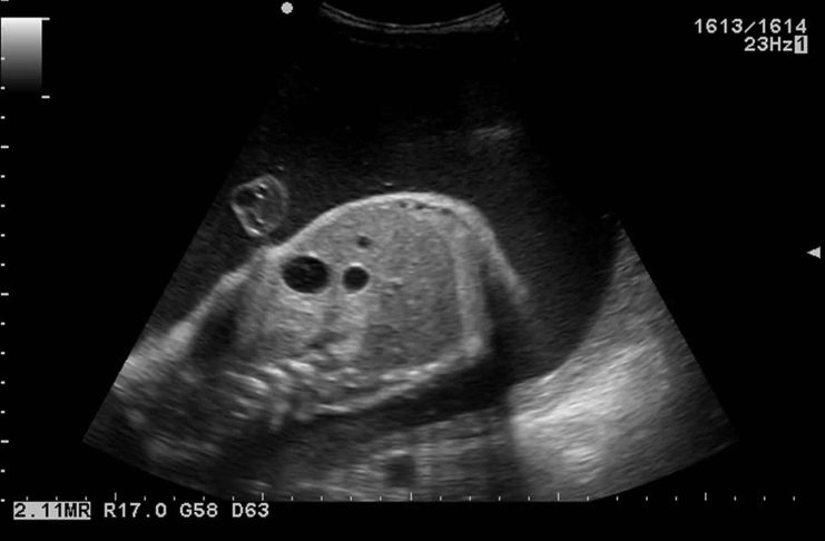duodenal atresia