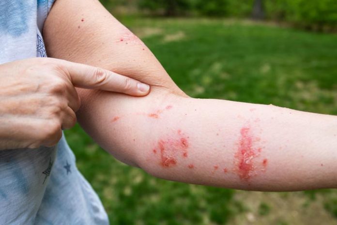 Is A Poison Ivy Rash Contagious 