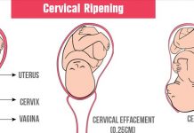 cervical ripening