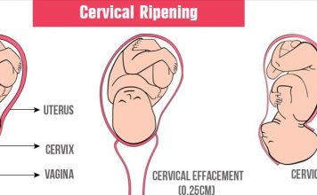 cervical ripening