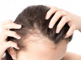 hairfall in women with pcos