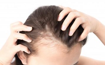 hairfall in women with pcos