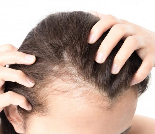 hairfall in women with pcos