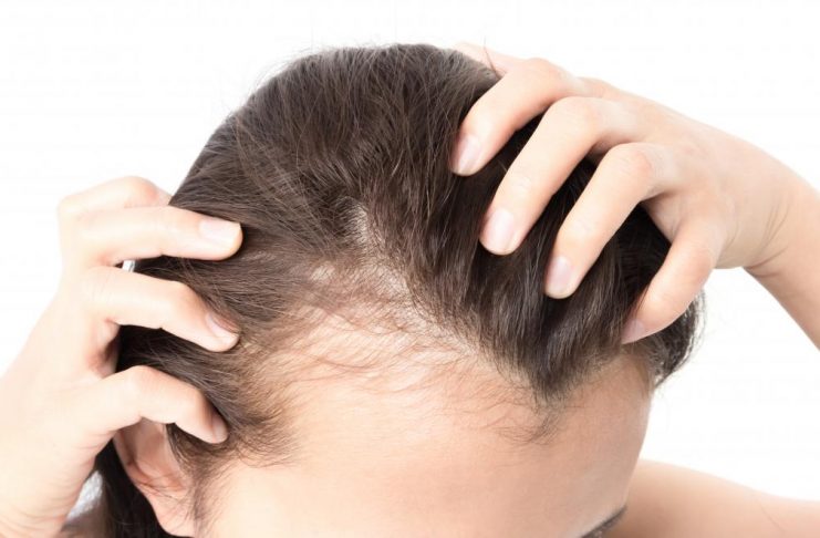 hairfall in women with pcos