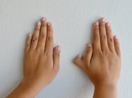 limb deformities in children