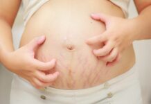 intrahepatic cholestatis of pregnancy