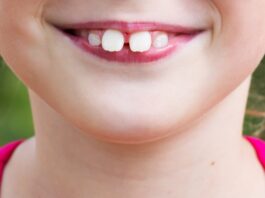 buck teeth
