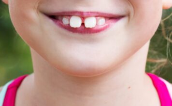 buck teeth