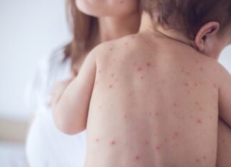 impetigo in children