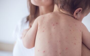 impetigo in children